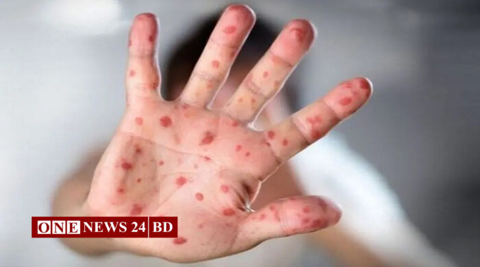 হাম ও হামের উপসর্গ নিয়ে দেশে আরও ১১ শিশুর মৃত্যু