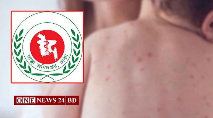 হামের উপসর্গে দেশে আরও ৫ জনের মৃত্যু